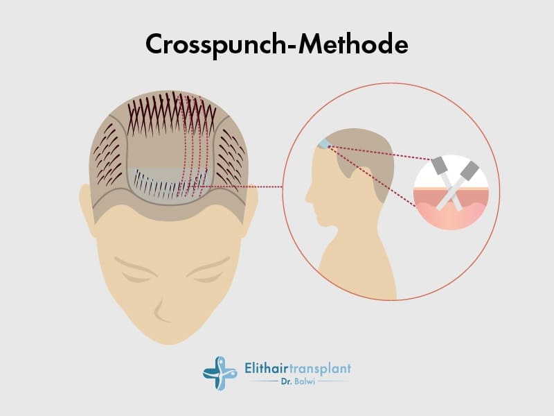 Haartransplantation mittels Crosspunch-Methode in einer animierten Darstellung