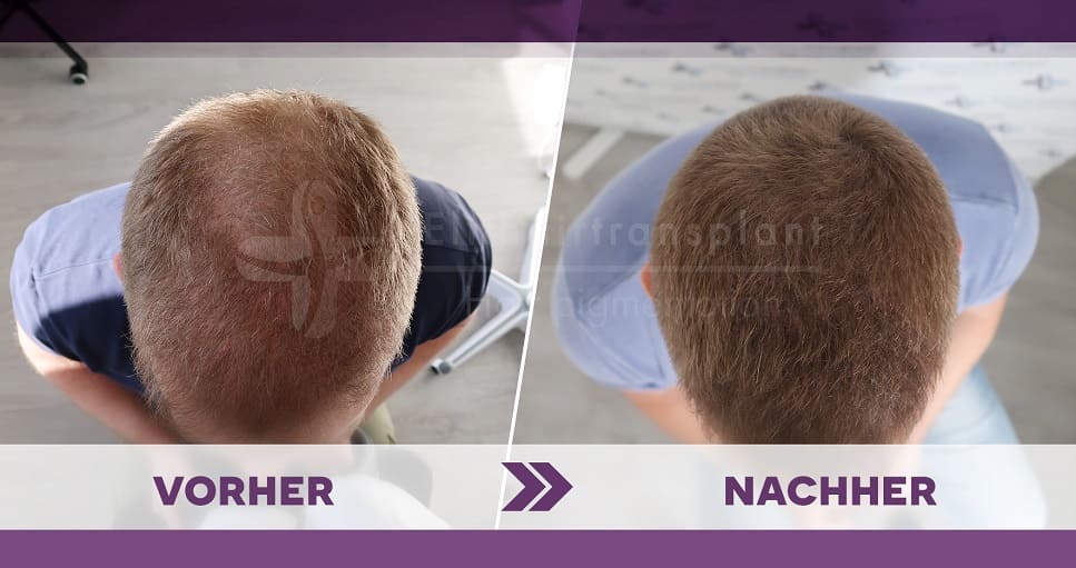 Mann senkt den Kopf und zeigt vorher nachher Vergleich bei einer Haarpigmentierung