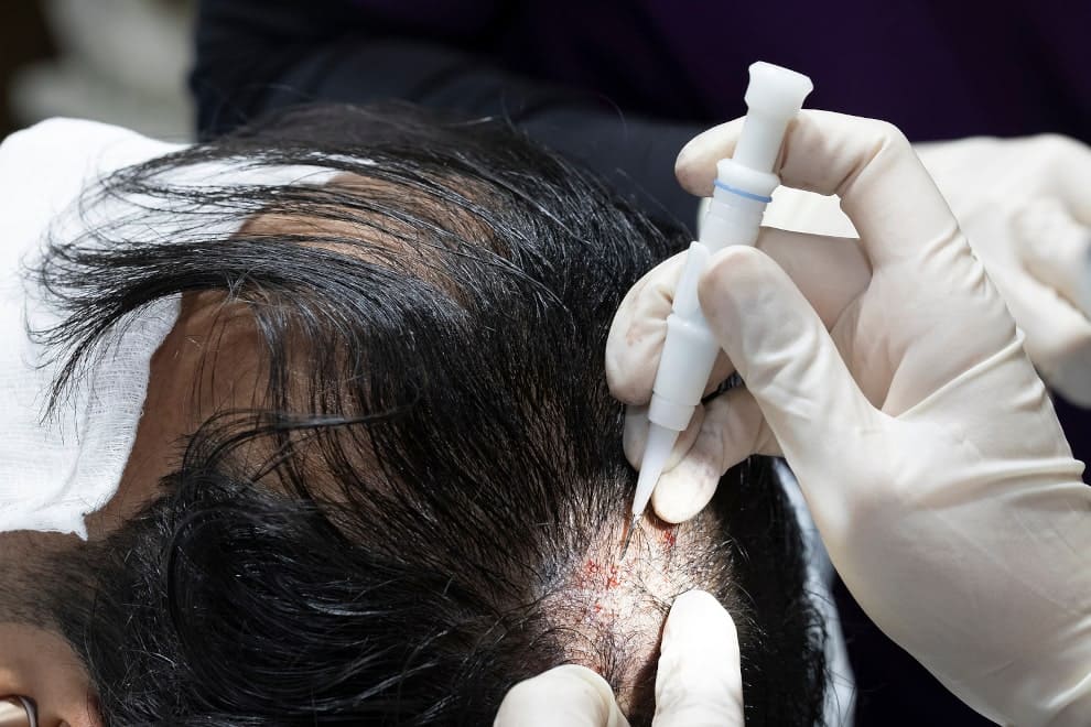 Arzt führt bei einem Patienten eine Haartransplantation durch