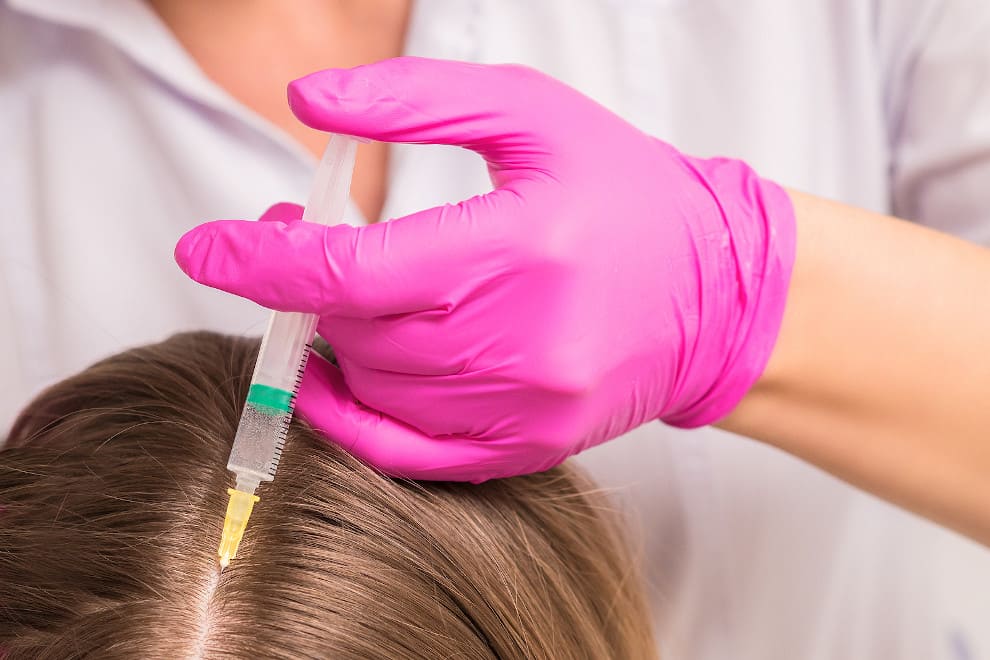 Nahaufnahme einer PRP-Injektion bei einem Haarausfall Patienten