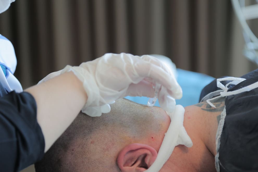 Mann liegt mit dem Gesicht auf einem Behandlungsstuhl und wird für die Haartransplantation vorbereitet