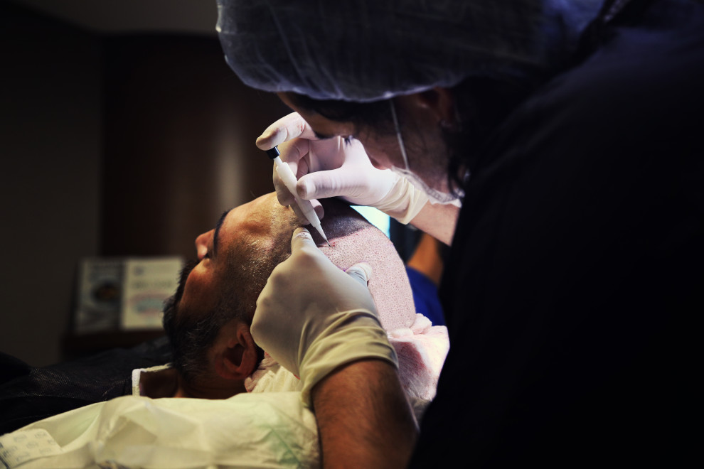 Haartransplantation mit DHI Implanter am Kopf eines Mannes