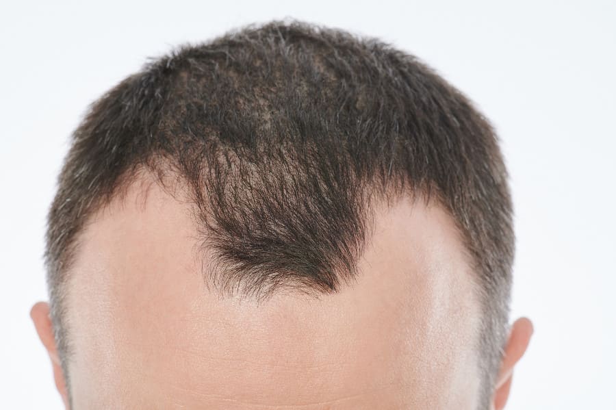 Frontalaufnahme eines Mannes mit Kopfhaut Pilz und Haarausfall