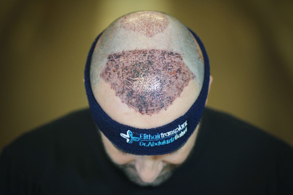 Ist Eine Haartransplantation Bei Hoher Stirn Geeignet Elithair