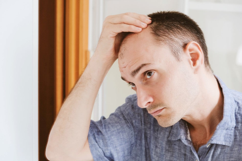 Mann denkt über Haartransplantation wegen Geheimratsecken nach