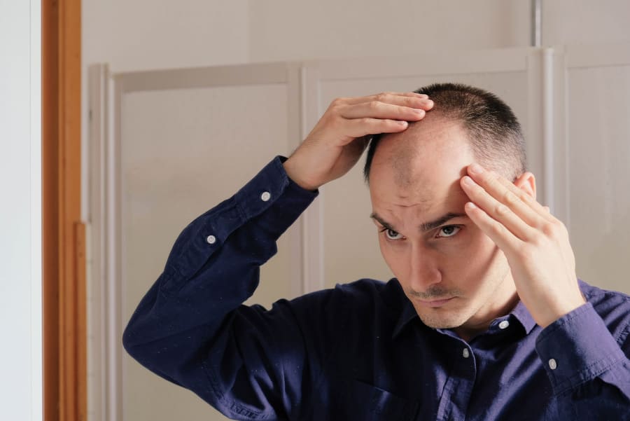 foto di un uomo che ha bisogno di un trattamento contro l'alopecia