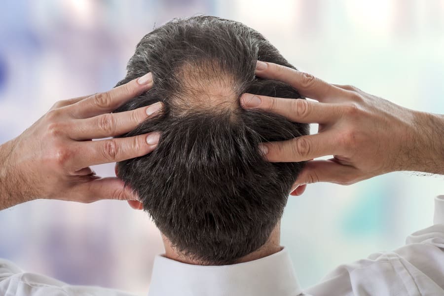 l'alopecia può essere causata sia da fattori ereditari sia da disfunzioni patologiche