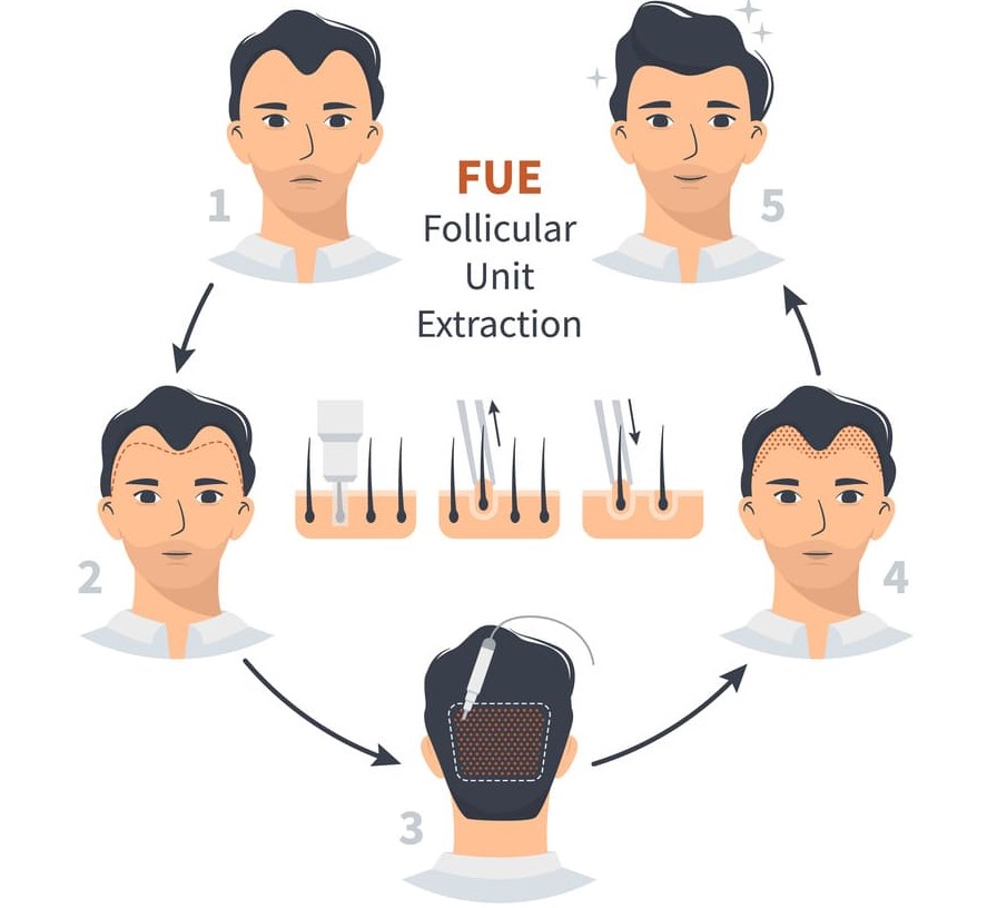 infografica che mostra la procedura della tecnica FUE di trapianto di capelli