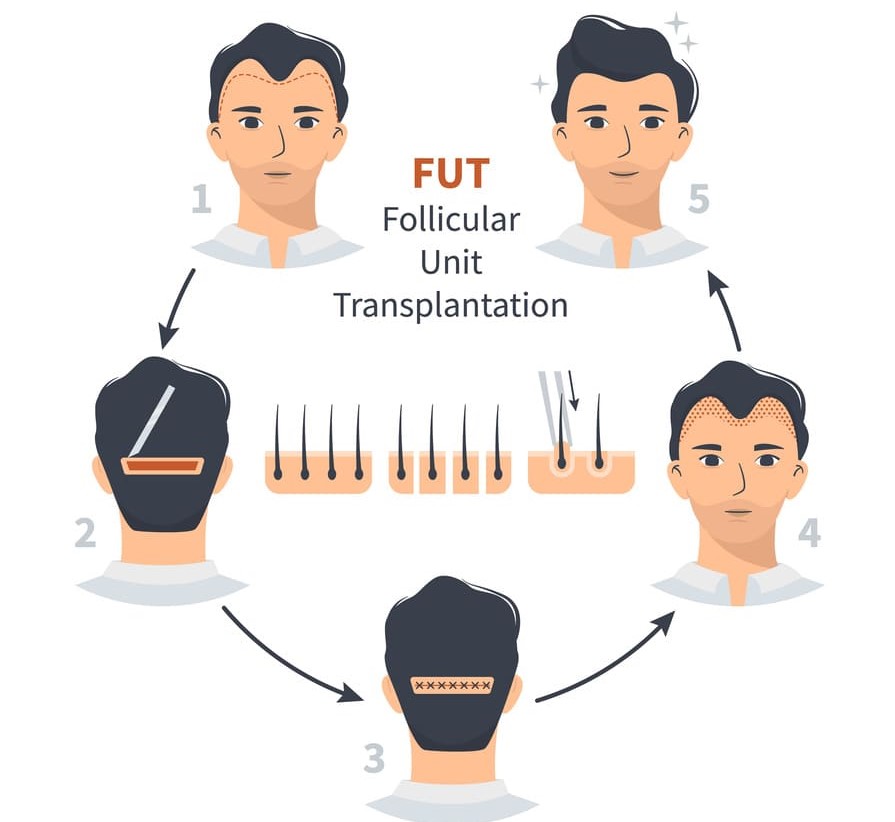infografica che mostra la procedura della tecnica FUT di trapianto di capelli