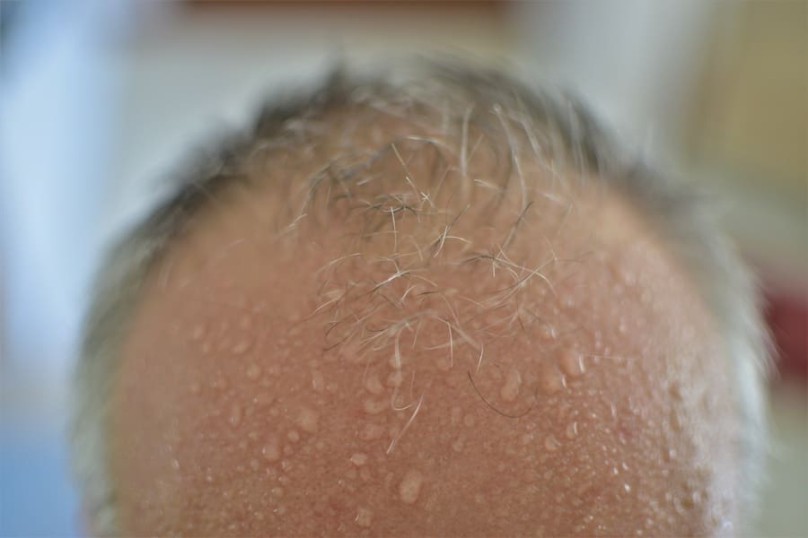 Il troppo sudore può causare l'iperidrosi del cuoio capelluto e indebolire i capelli