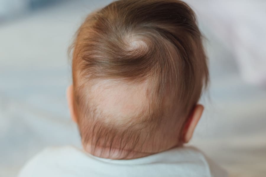 l'alopecia nei bambini causa un diradamento dei capelli nella parte posteriore della testa