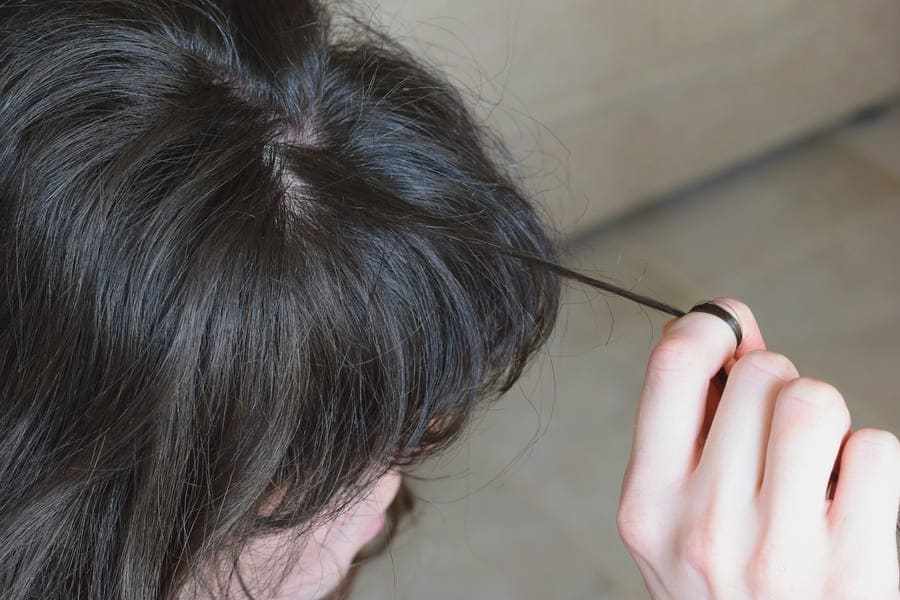 l'alopecia da tricotillomania è un disturbo che porta a strapparsi i capelli