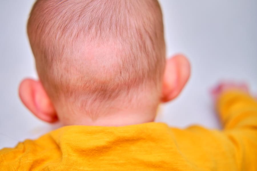 la formazione di una chiazza glabra è un sintomo dell'alopecia nei bambini