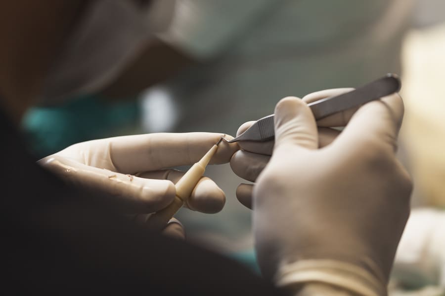 foto dell'implanter utilizzato per aprire i canali durante il trapianto di capelli sintetici
