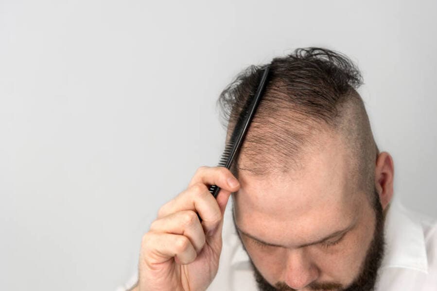foto di un uomo che soffre di perdita di capelli nella parte superiore del capo