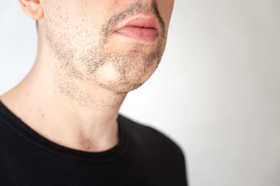 l'alopecia della barba si manifesta con delle chiazze glabre sul viso