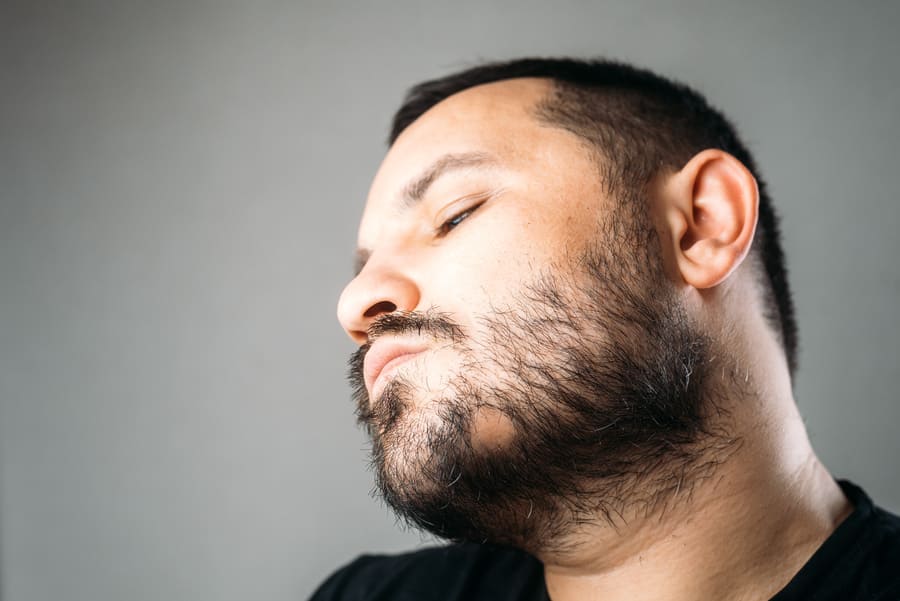 foto di un uomo che soffre di alopecia della barba