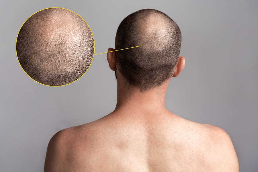la perdita di capelli genetica inizia a svilupparsi dalla parte posteriore della testa