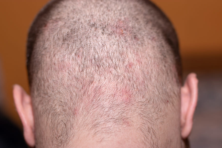 testa di un paziente colpita da brufoli post trapianto di capelli