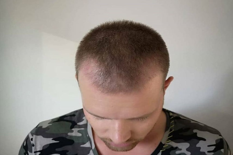foto di un paziente che mostra lo stato del trapianto di capelli dopo 2 mesi