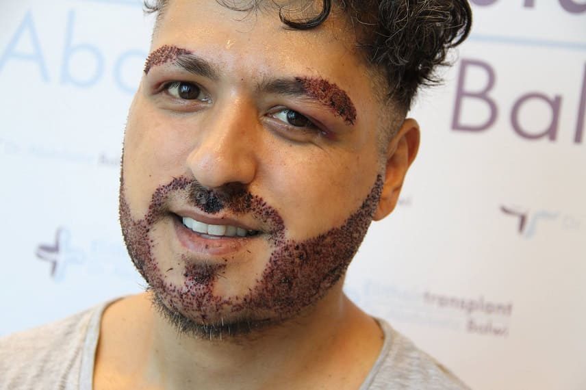 foto di un paziente che ha effettuato un trapianto di barba