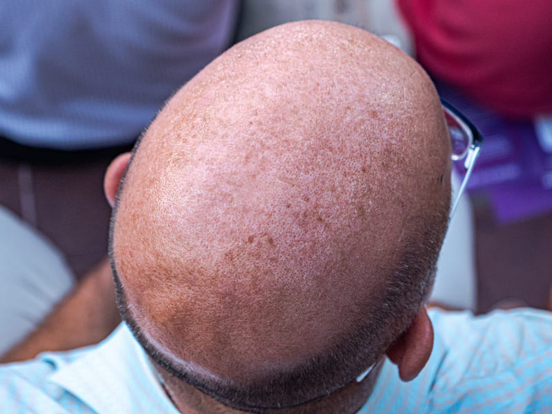 foto di una testa che ha preso troppo sole dopo un trapianto di capelli