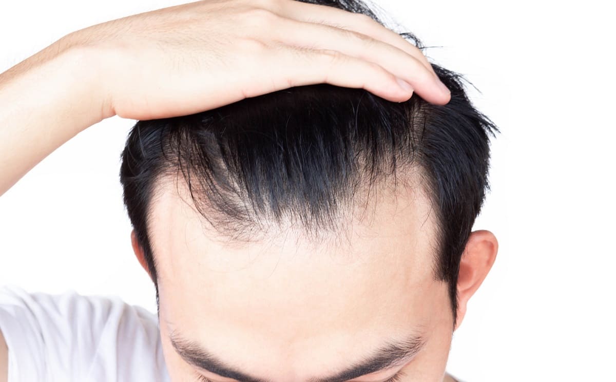 foto che mostra la ricrescita dei capelli in un uomo