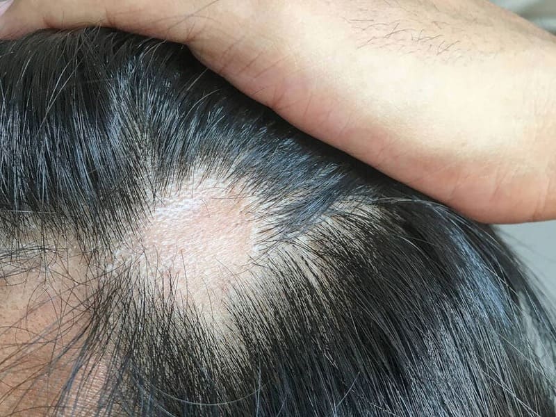 l'alopecia cicatriziale causa la perdita dei capelli intorno a una cicatrice