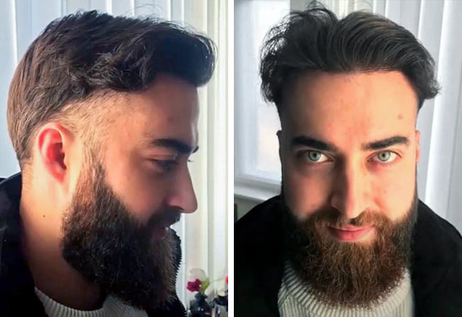 foto del Prima e dopo il trapianto di barba zaffiro da 4250 innesti fatto da andre ulbrich quando sono passati 8 mesi
