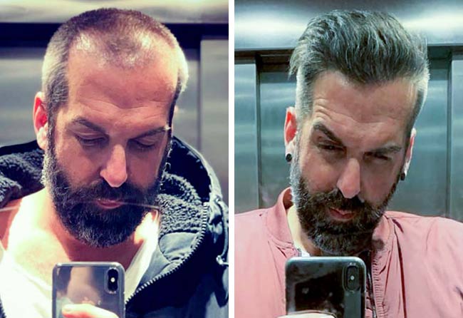 Foto di Prima e dopo il trapianto di capelli zaffiro con 3400 innesti fatto da juergen t