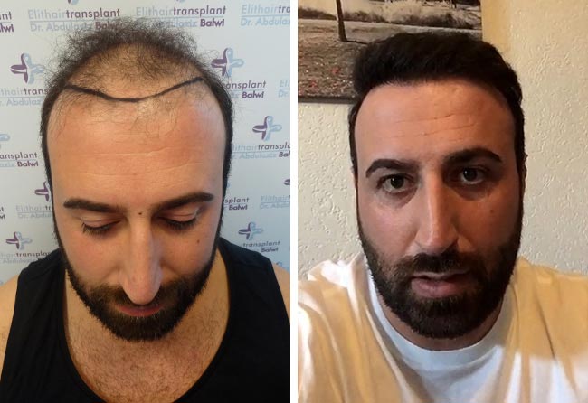 Foto di Prima e dopo il trapianto di capelli zaffiro con 3500 innesti fatto da artin asrian