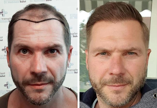 Foto di Prima e dopo il trapianto di capelli zaffiro con 4100 innesti fatto da marcus medwed
