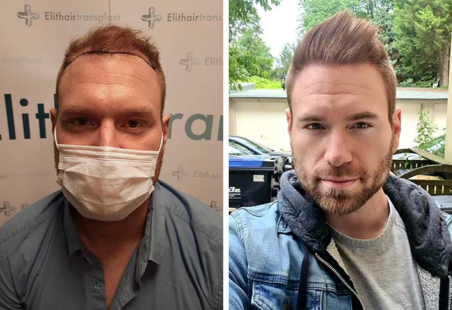 Foto di Prima e dopo il trapianto di capelli zaffiro con 4500 innesti fatto da Kewin Lenzig