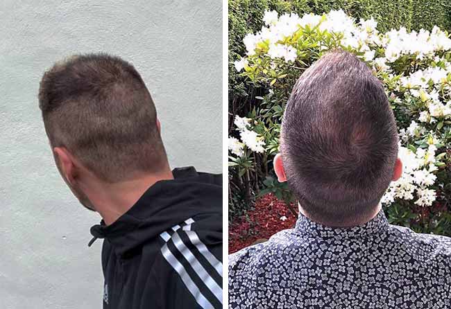 Foto prima e dopo del trapianto di capelli di Andre con zona donatrice dopo 5 mesi