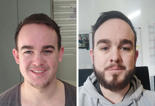 foto del prima e dopo il trapianto di barba zaffiro da 4300 innesti fatto da oliver george dyllick