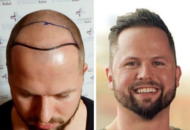 Foto di Prima e dopo il trapianto di capelli zaffiro con 2800 innesti fatto da Nico Gumlich
