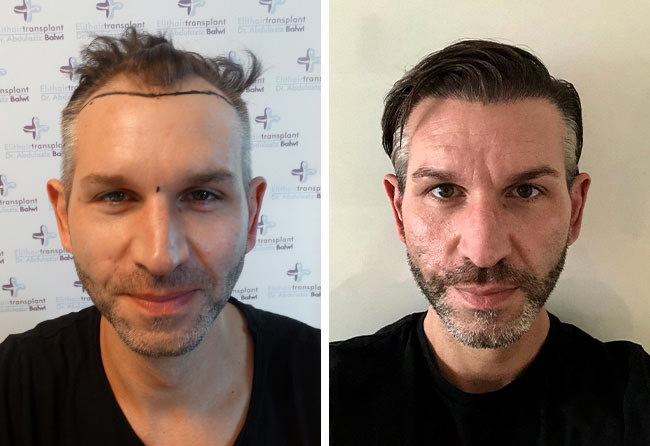 Foto di Prima e dopo il trapianto di capelli zaffiro con 4250 innesti fatto da thomas schreier