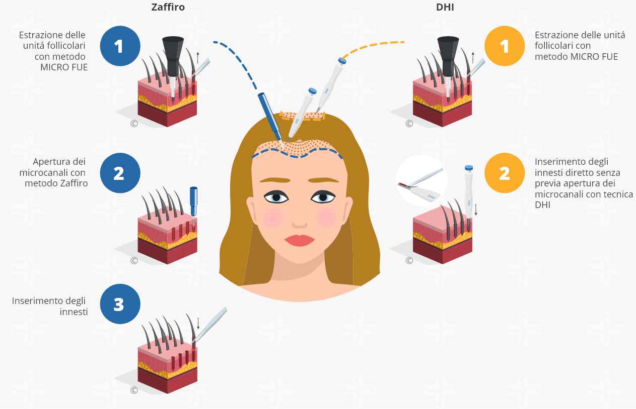infografica che mostra il processo di trapianto di capelli SDHI