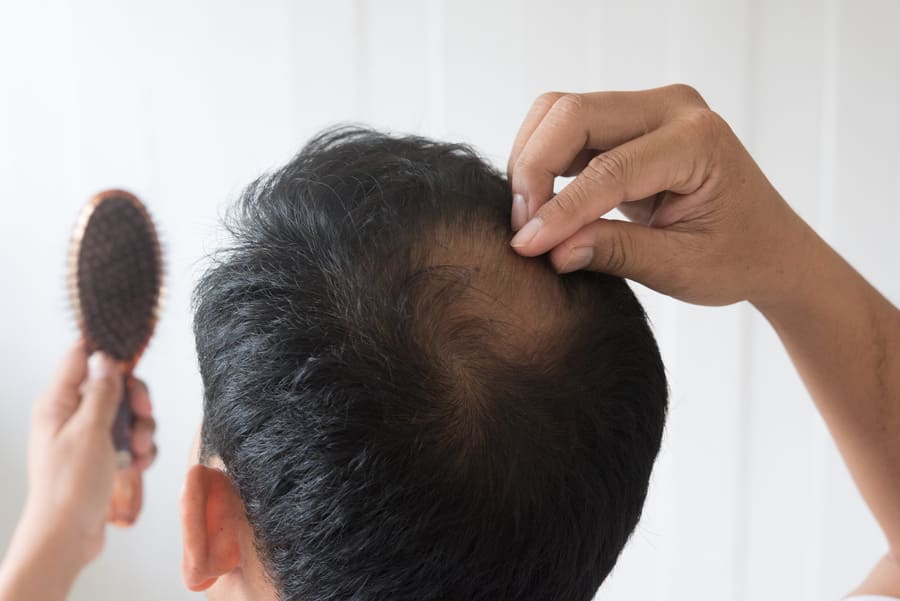 retro della testa di un uomo colpito da alopecia androgenetica