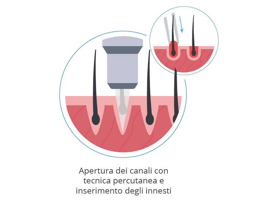 Infografica che mostra il processo di apertura dei canali e l'inserimento degli innesti nella zona donatrice durante un trapianto di capelli
