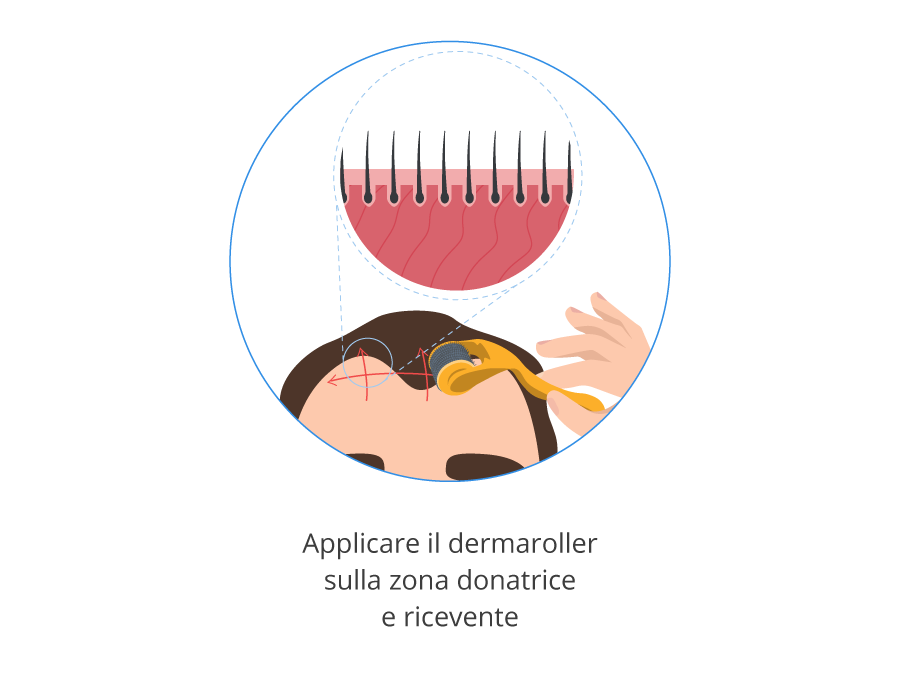 Infografica che mostra come applicare il dermaroller sulla zona donatrice e ricevente prima del trapianto di capelli