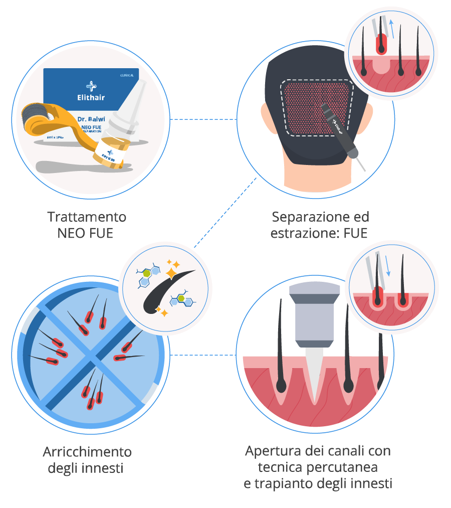 Infografica che mostra la procedura del trapianto di capelli percutaneo