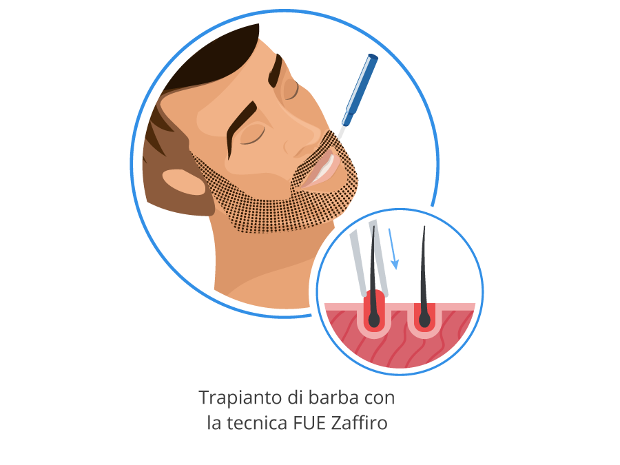 Infografica che mostra come funziona il trapianto di barba con tecnica FUE Zaffiro