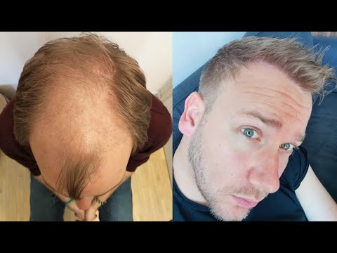 thumbnail prima e dopo il trapianto di capelli di un paziente Elithair