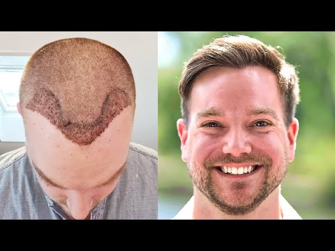 thumbnail prima e dopo il trapianto di capelli di un uomo