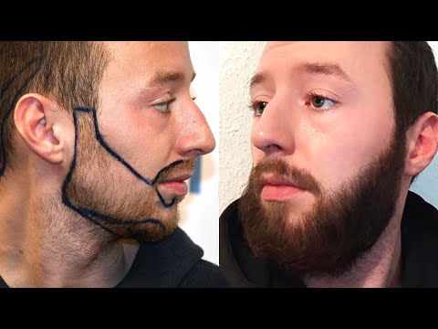 thumbnail prima e dopo un trapianto di barba con elithair