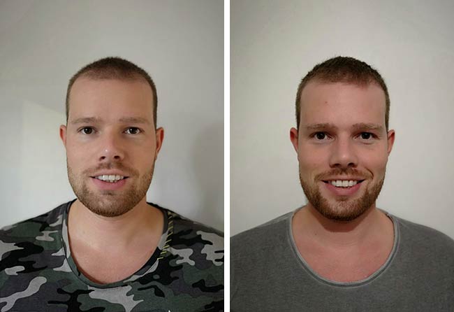 foto del Prima e dopo il trapianto di capelli zaffiro da 2800 innesti fatto da alexander kitzel nel 3 mese