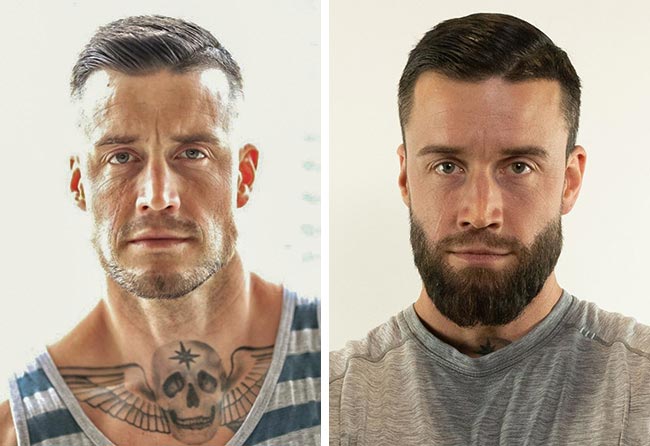 foto del Prima e dopo il trapianto di barba Zaffiro da 4200 innesti fatto da jhaki joachim schuricht