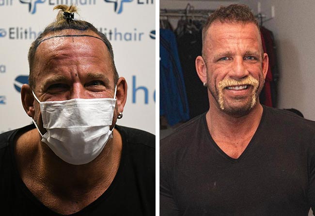 foto del Prima e dopo il trapianto di capelli DHI da 2900 innesti fatto da hollywood matze