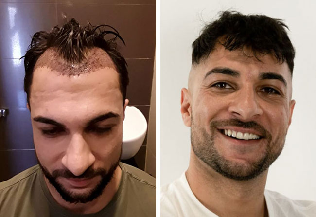 Foto di Prima e dopo il trapianto di capelli zaffiro con 2200 innesti fatto da Osmani Perparim